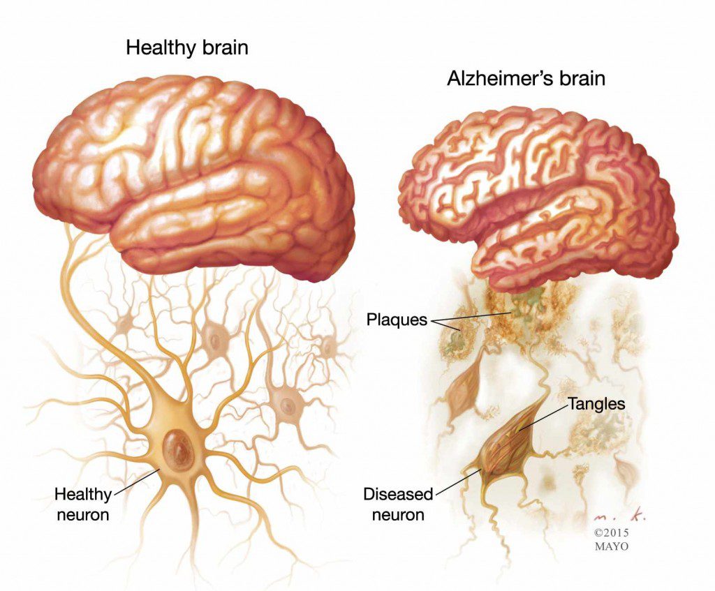 21 Eylül Dünya Alzheimer Günü